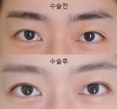 매몰 했어요