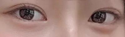 절개눈매교정 후기