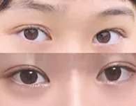 쌍꺼풀 재수술