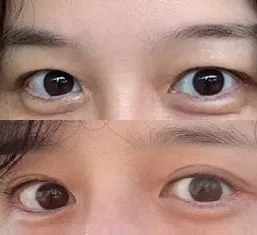 눈썹거상술 후기
