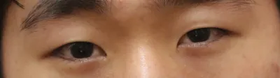 일주일째! 오늘 실밥 풀었어요~!