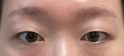 시술 전이랑 시술 후랑 인상이 많이 달라졌는데 매우 만족하고 있습니다 ≡