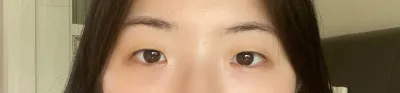 베리굿 성형외과 최태준 원장님께 눈성형을 받기로 결정했습니다.