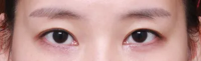 수술한지 10년째가 되니 라인도 흐려지고 좀만 부으면 한쪽은 거의  풀린것처럼 되어서 서칭해보고 찾아간 베리굿.