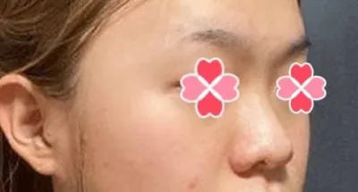 코 수술 하고 나서 전체적으로 인상이 좋아졌단 소리를 많이 들어요 ㅎ