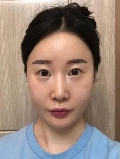 베리굿에서 재수술한지 벌써 3개월째에요!