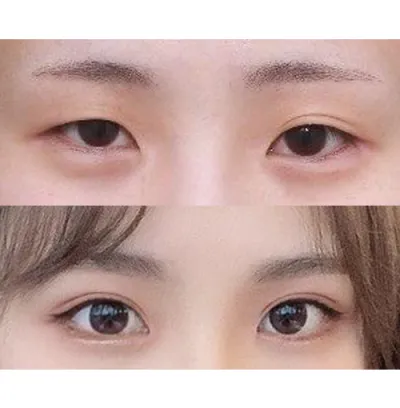 수술한지는 3개월차에요