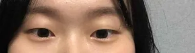수술한 지 2개월 조금 넘었어요 !