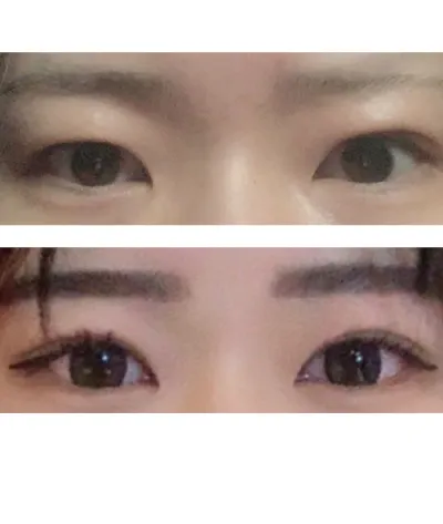 쌍커풀 수술을 하고 지금 너무 맘에 들어서 좋아서 게시글 올린다