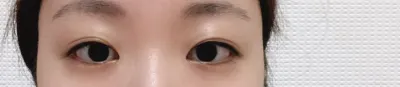 수술 후에도 원장님께서 경과 봐주셨는데 이렇게 환자 소중히 봐주시는 분 드문 것 같아요!! 후기남겨드립니다