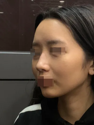 베리굿에서 첫 코 성형했습니다.! 베리굿!