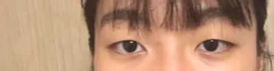 수술해주신 박상욱 원장님과 상담해주신 실장님 두 분 모두 매우 친절하게 잘해주셔서 첫 수술인데 떨지 않고 했네요 감사합니다 !~~