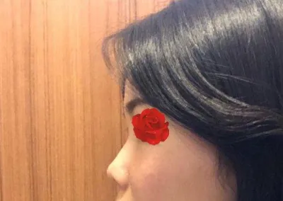다른 원장님께 수술했다면 절대 이만큼의 높이가 안나올거라고 생각해서 절대 후회하지 않습니당~~!!