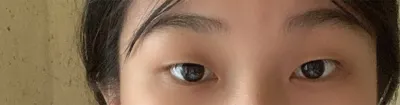 원장님도 친절하고 간호사 언니들도 친절한 베리굿에서 쌍수 했어유~~~!