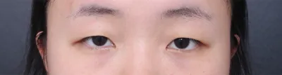 수술 전 눈은 졸려보이고 사나워보여서 쌍수를 경심하고 여름방학맞춰서 수술 진행했씁니다!