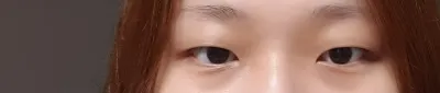 절개,눈매교정,앞트임 받았어요!~ 후기남겨드립니다