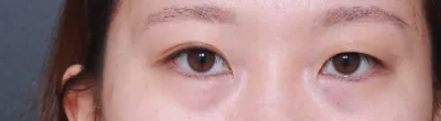 상담도 만족스웠고 수술과정,결과도 아주 만족이에여