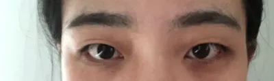 김준현 원장님 완전 감사합니다!!! 저저는 자연유착이랑 앞트임을 했어요!