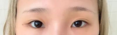 눈 재수술 베리굿에서 하였는데 눈이 확실히 트여서 조아요~후기남길게요