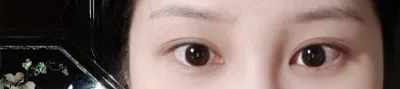 수술후 1달째입니다. 베리굿 첫눈 이벤트 보고 수술받았어요