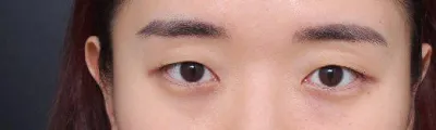7월 말에 첫눈수술하고 이제 3개월차 정도 됐네요!