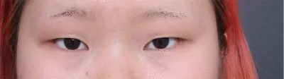 눈 수술 후기에욧~