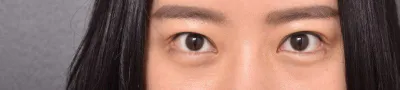 눈재수술 고민인 분들 강추강추!! 합니당