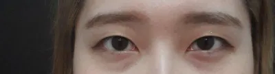 눈수술 한지 한달반 된 후기예요>