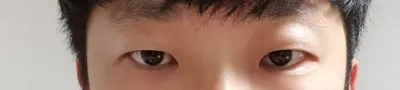 지금은 수술 3달 뒤 모습이고 지금은 너무 자연스럽게 자리잡게되어 만족스럽게 생활하고 있어요