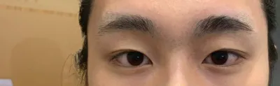 눈을 크게떠도 이제 쌍커풀 라인이 다보이니까 사진찍을때도 행복하고 얼굴에 자신감이 생기는거같아요