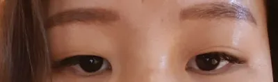 5월11일에 자연유착매몰 + 앞트임 진행 했어요~