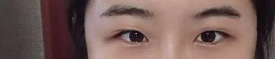 재수술이라 신중했는데, 잘 선택한 것 같네요~