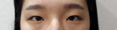 ♥쌍수후기♥