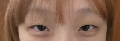수술한 지 3달정도 되었는데 붓기가 점점 빠지면서 자리 잡고 있는거 같아요!!