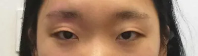 눈절개, 앞트임 수술받은지 두달 넘엇어요