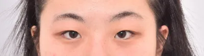 눈수술 자연스럽게 됐어요~