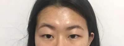 베리굿성형외과 김준현 원장님께 이마거상과 매몰 눈매교정 했습니다.