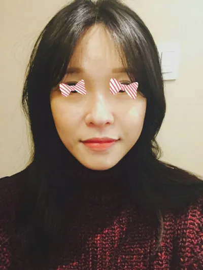 얼굴자가지방이식!