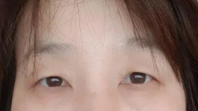 눈 수술후기
