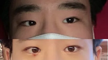 눈 수술후기