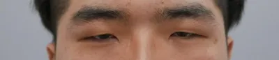 눈 수술후기