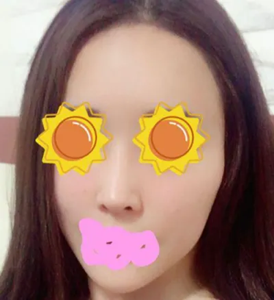 안면윤곽 | 기타 수술후기
