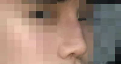 코 수술후기