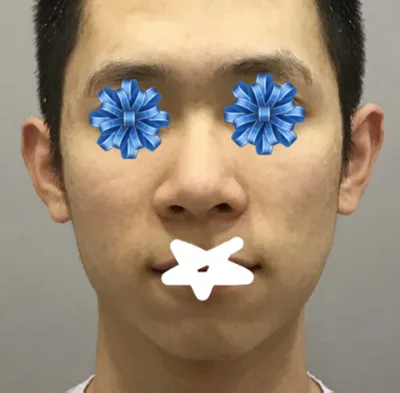 코 | 안면윤곽 수술후기