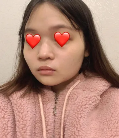 코 | 안면윤곽 수술후기