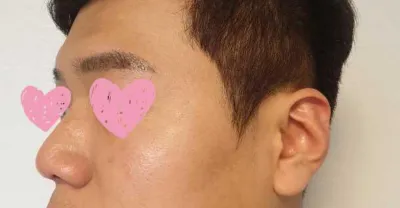 코 수술후기