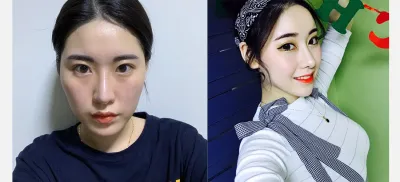 안면윤곽수술