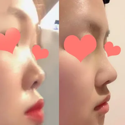 코수술후기!!