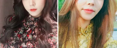 입꼬리 필러