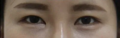 # 쌍꺼풀(매몰) # 눈재수술